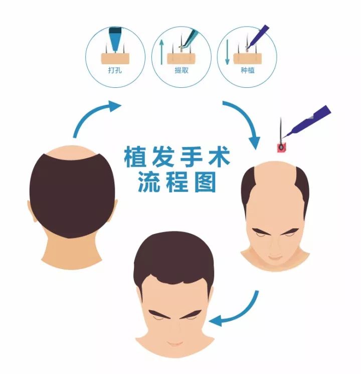 新生植发