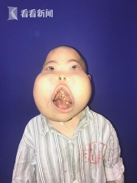 河马男孩九院手术 康复路上点燃希望|手术|张