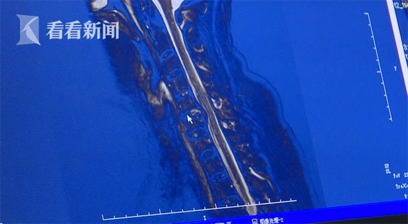 视频|女子打完麻将突然上肢疼痛麻木 原是久坐
