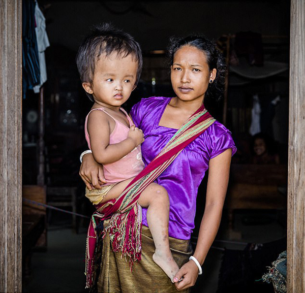 印女童患致命脑水肿脑袋是正常孩子两倍大|印