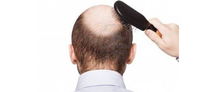 脱发分七级,你在哪一级?治疗方法看这里!|脱发