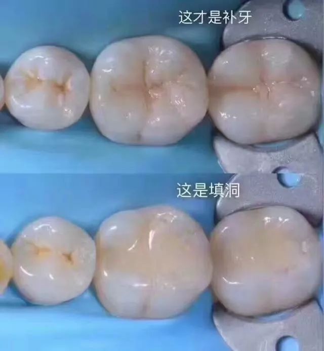 而树脂美学修复和传统补牙的最显著差别在于,修复完成后牙齿形态和