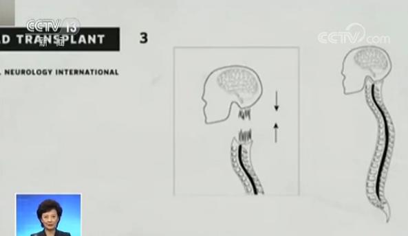 中国教授完成全球首例人类“换头术”耗时18小时