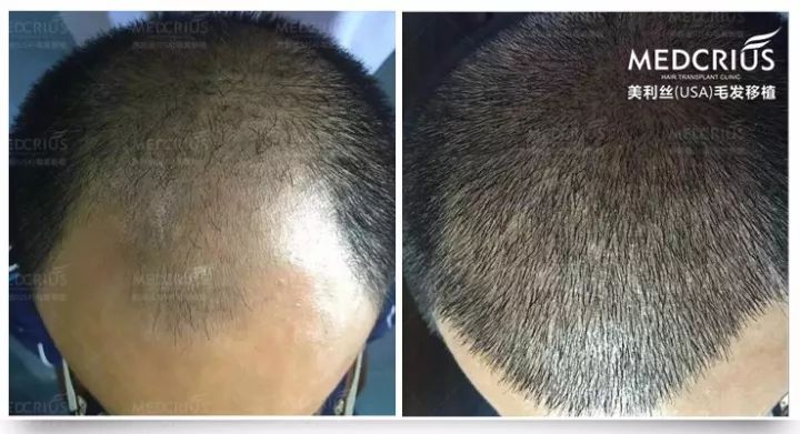 治脱发擦生姜?当心用错变秃头!脱发、秃顶、前