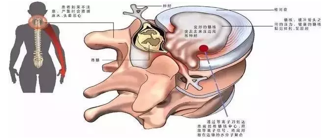 按摩被按成瘫痪?东莞上周已出现了2例!|颈椎病