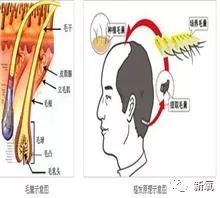 溢脂性脱发