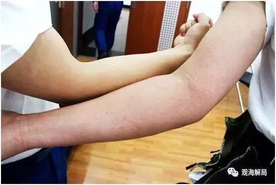 (训练后胳膊上满是毛细血管压破后的血点)