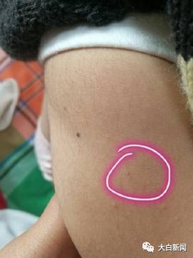 家长供给的孩子身上针眼照片