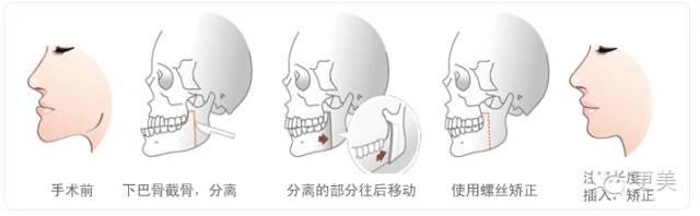 反颌外科手术示意图