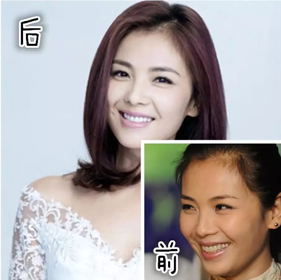 刘涛之前在微博上说过自己做"美容牙"的血泪史很痛苦,告诉大家要好好