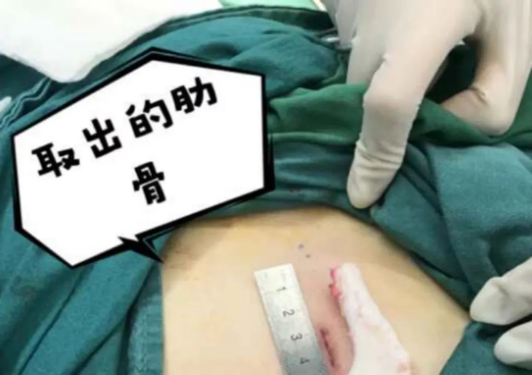 肋软骨隆鼻 你怕了么