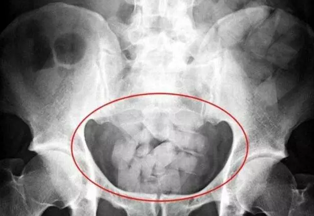 梦想一夜暴富?告诉你,人体藏毒危险不仅仅是牢