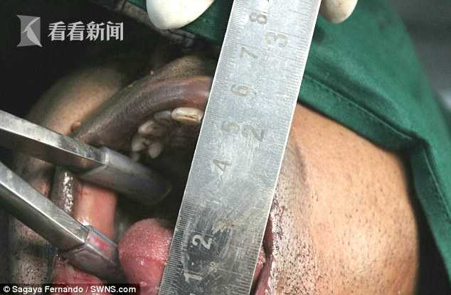 b8701d08e7603b0fd3fd9023ca6ed90e.jpg 印度男子1岁时摔跤磕到下巴 38年张不了嘴吃流食