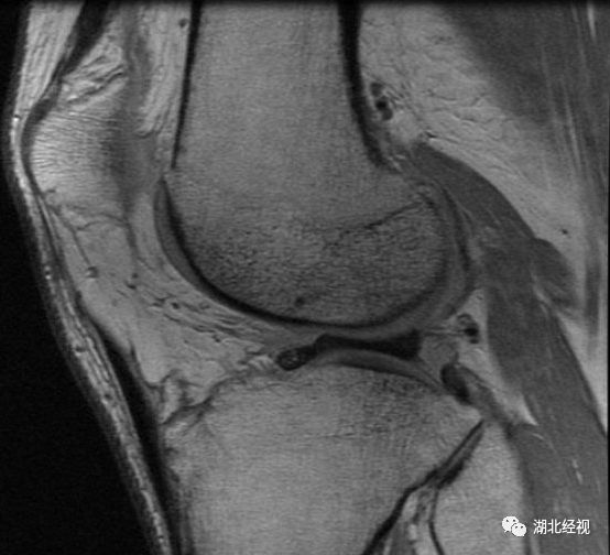 明星都在穿的暴汗服真能瘦得快?小心会导致