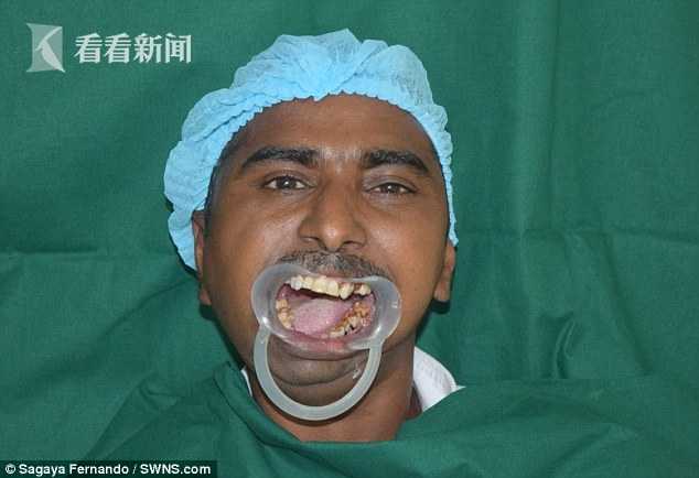 印度男子1岁时摔跤磕到下巴 38年张不了嘴吃流食