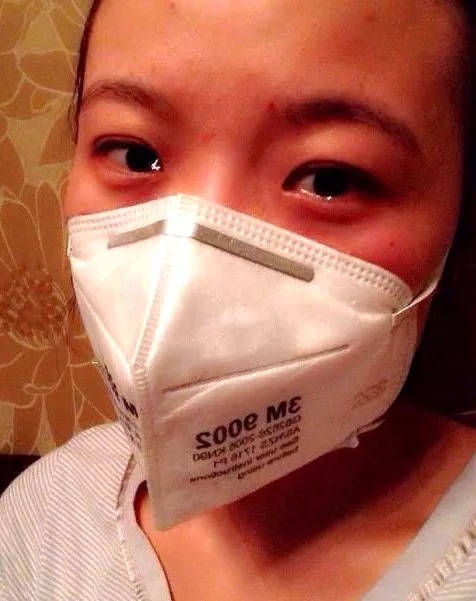 过敏性鼻炎成为榆林人民的痛!榆林下决心治理