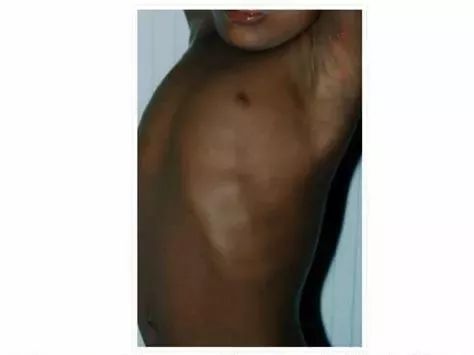 肋骨外翻是缺钙?还是缺维生素D?