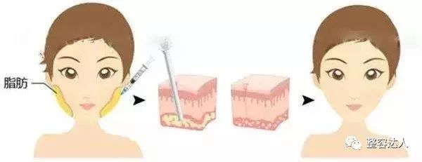溶脂针和瘦脸针区别在哪里