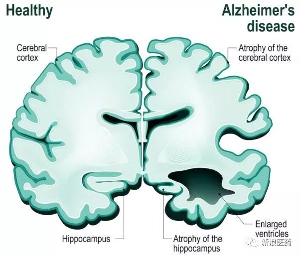 预防小脑萎缩的方法有什么呢?