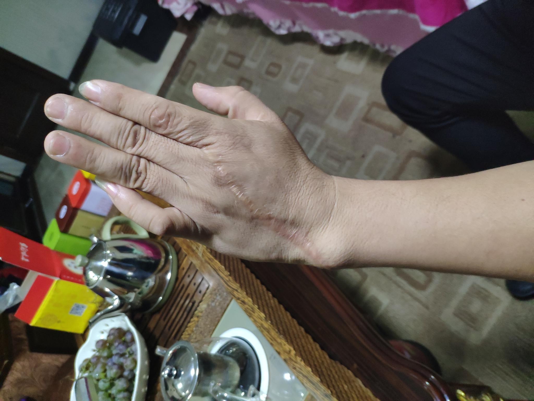 王永宏向记者展示其手上的伤疤，其小拇指至今无法伸直。新京报记者 卢通 摄