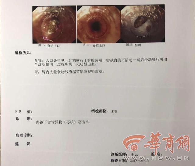 4人吃粽子卡住食管 医生呼吁禁止带核枣做食物