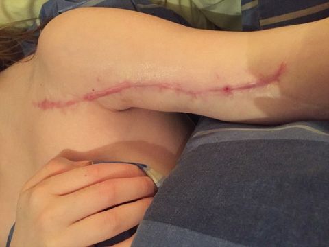 11岁女孩在癌症治疗后手臂骨碎裂,医生给她安装了钛金属替代物,使她重