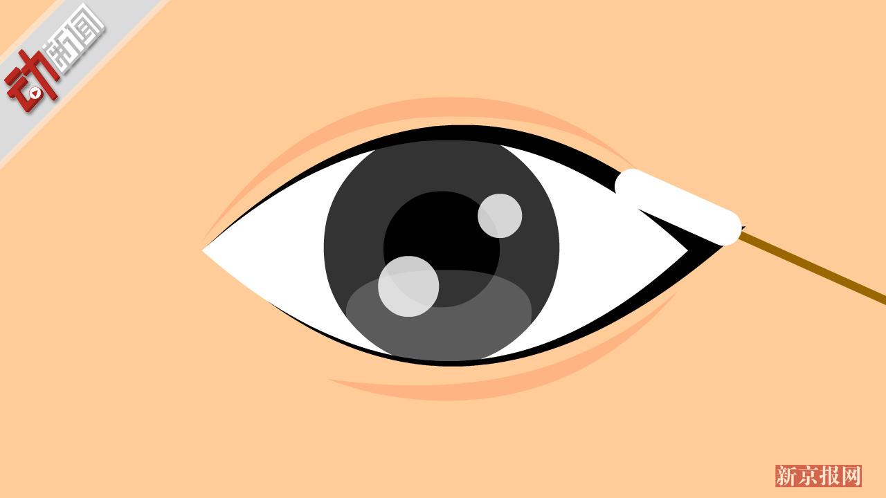 杭州女子浓妆13年睡觉也不卸 眼睛长出结石