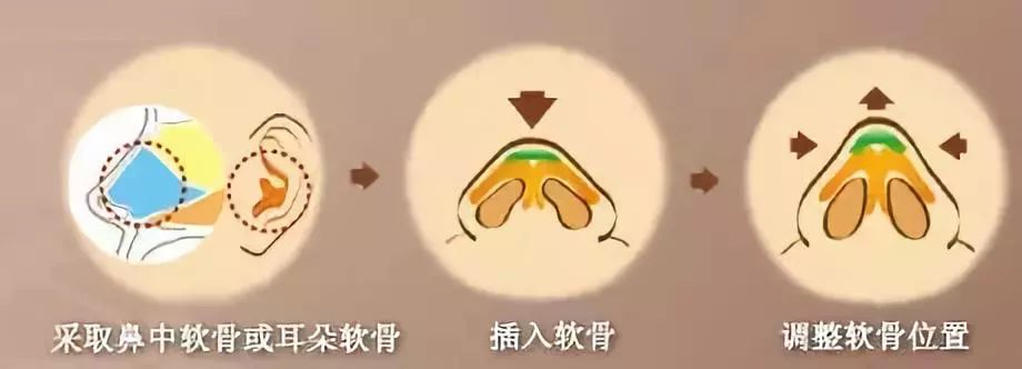 什么样的鼻子才叫好看