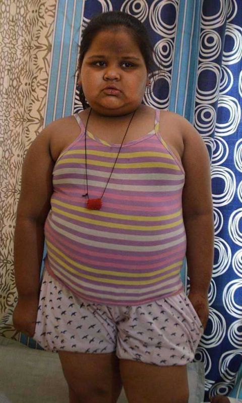 印度8岁小女孩病态肥胖,体重114斤, 一天吃掉3斤米饭