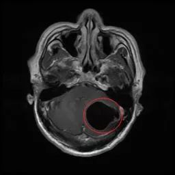 ↑（术前头部MR，左侧小脑半球内一较大的囊性占位，压迫小脑、脑干，为囊虫病变。“黑色空洞”部分即为囊虫病灶）