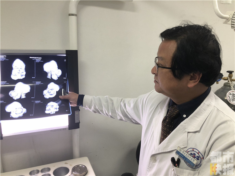旬邑县一女子面部畸形25年 咀嚼困难失去嗅觉