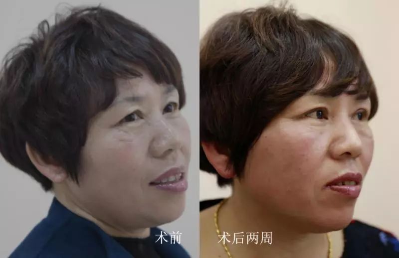 眼皮下垂矫正手术两周后的黄葱兰