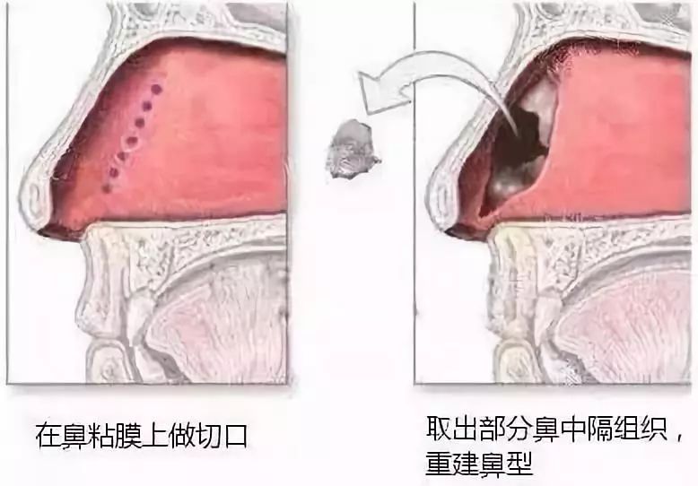 鼻中隔软骨