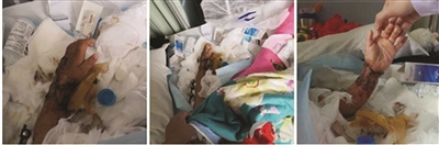 两岁娃断臂，保命还是保手？但这次医生的情感战胜了理智……