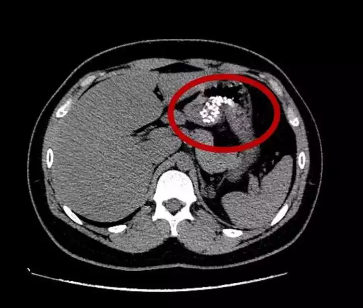 杭州16岁男孩肚子痛 ct片吓坏众人:胃里一堆"白点点"