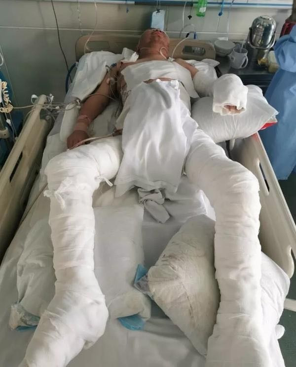助3000残疾人就业,“残梦”英雄大面积烧伤后受郑州慈善救助