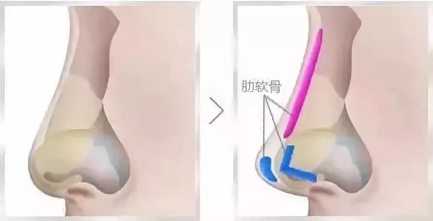 肋软骨隆鼻的优势