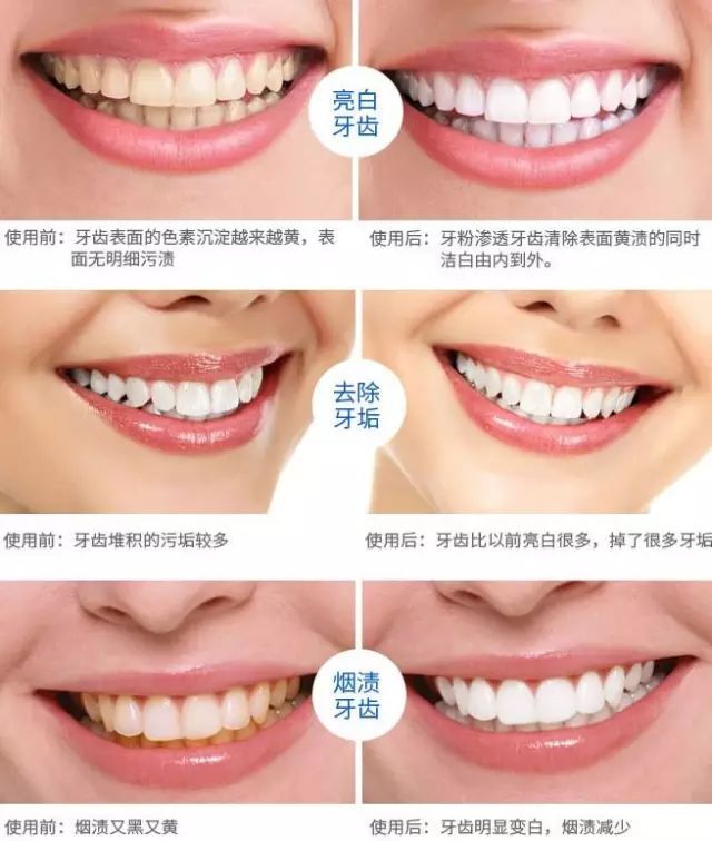 2分钟拯救口臭和黄牙!牙垢牙渍轻松溶解,清新口气12小时!