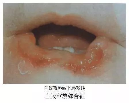 家族男孩全夭折 只因患罕见病把自己咬得血肉模糊