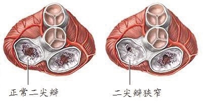 什么叫二尖瓣型心脏 0lF9-hhnunsr1696211.jpg