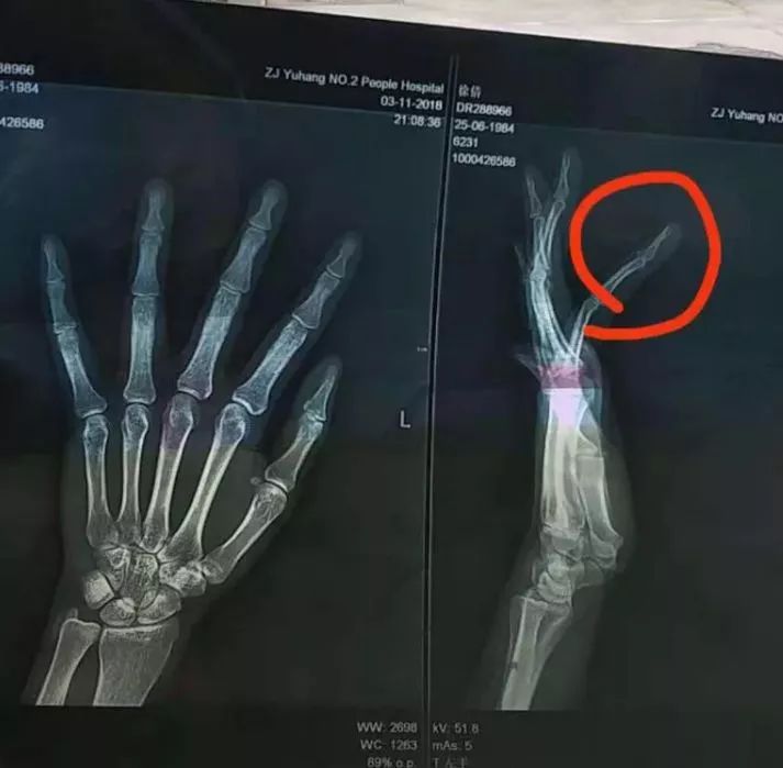 徐女士手指骨折的x光片.