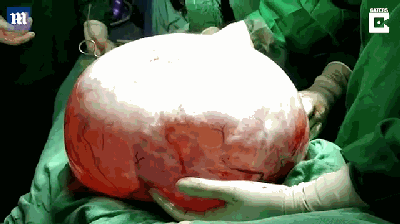 女子腹痛7月隆起巨肚 医生摘除直径1.06米囊肿