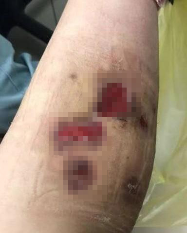 杭州女子打步骤针后皮肤溃烂险排查,瘦身数月pssc6教程瘦腿截肢图图片