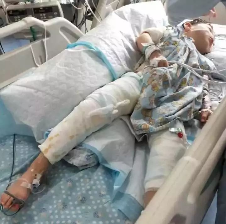 捅了一下电瓶插孔,8岁女童手指被电灼伤,骨头都露出来了!