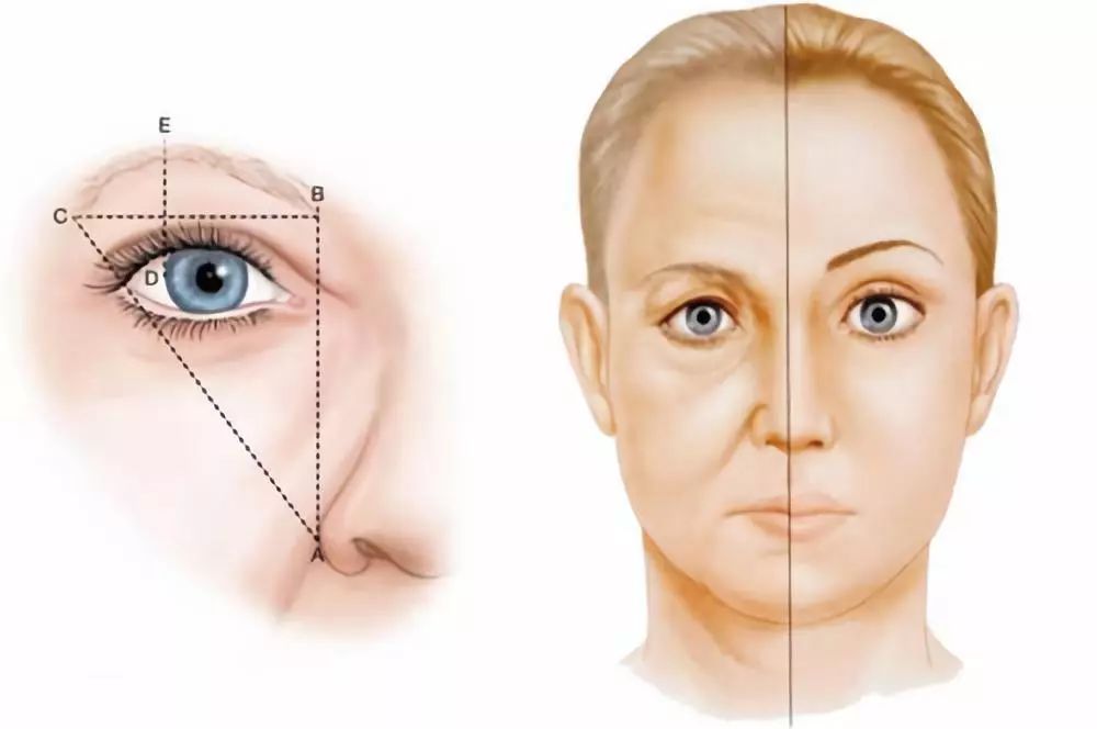 切眉术真的能让人看起来年轻10岁