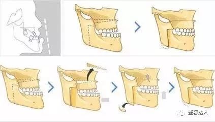 双鄂手术