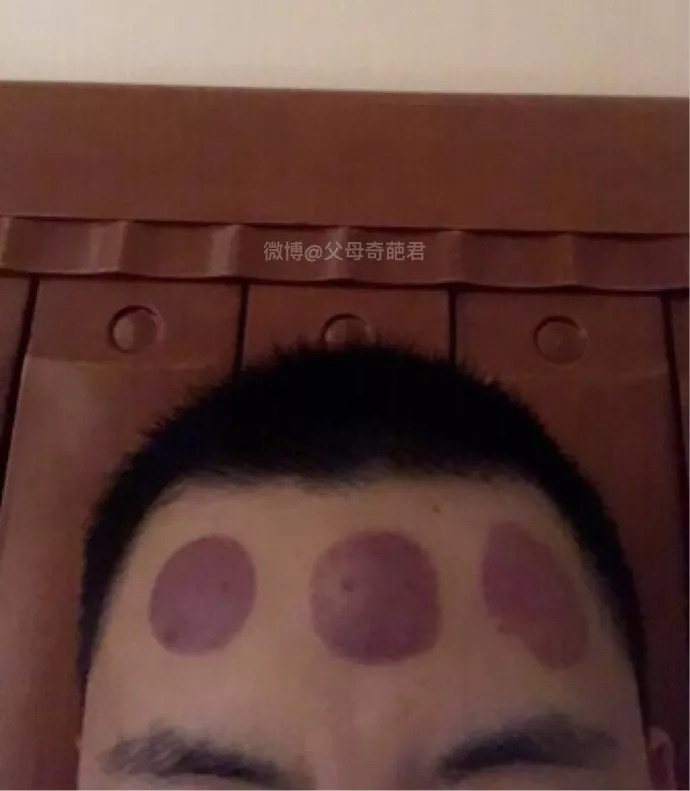 图:一网友额头上长了一个痘痘 他妈妈认为是有湿气,于是