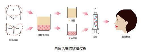 自体脂肪移植