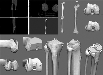 3D打印能为你“私人订制”人工关节