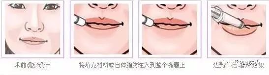 自体脂肪颗粒注射